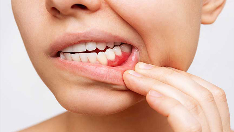 GUM TREATMENT