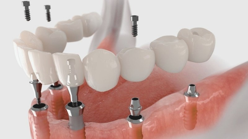 IMPLANT PROCEDURE