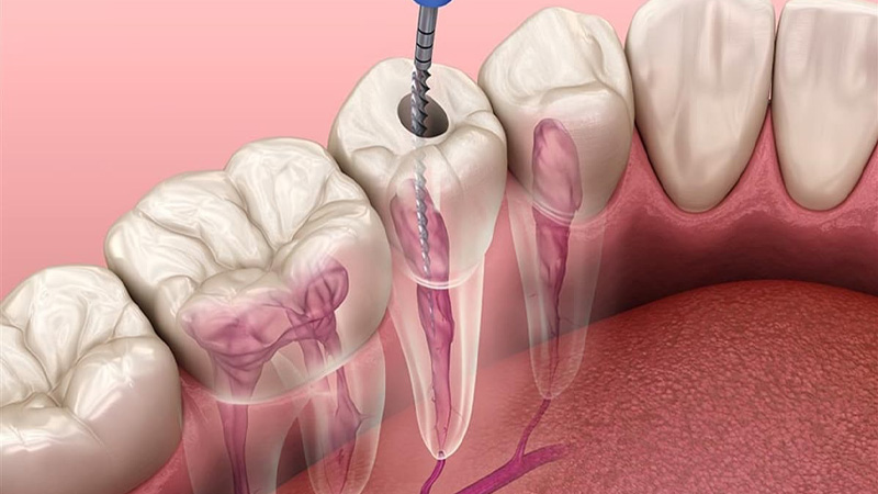ENDODONTIC TREATMENTS