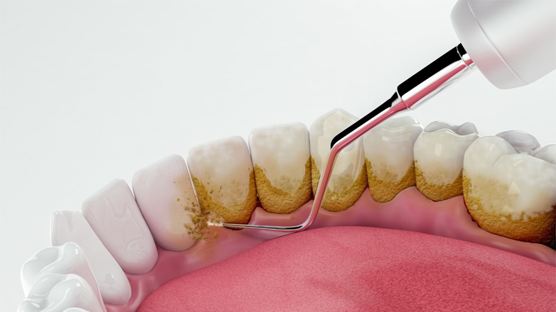 Dental cleaning