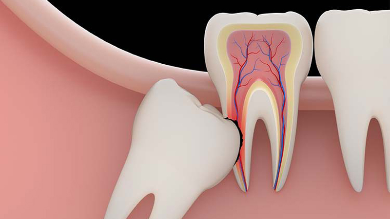 IMPACTED TOOTH EXTRACTION