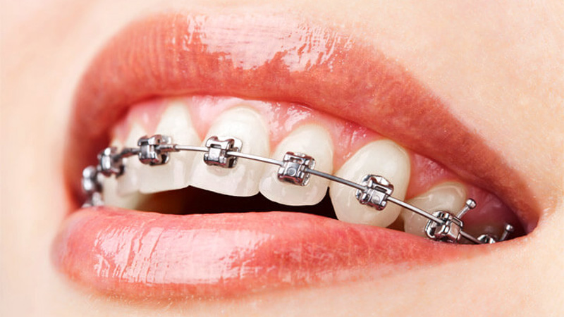 ORTHODONTIC TREATMENT