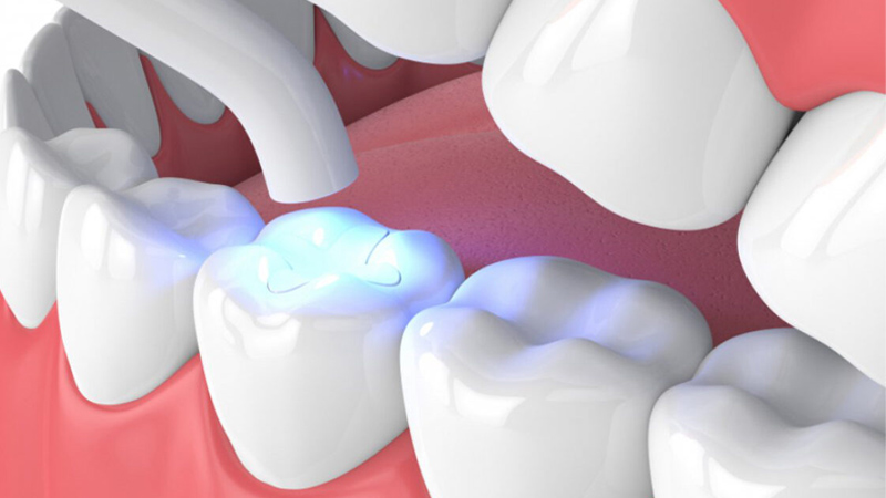 DENTAL FILLING