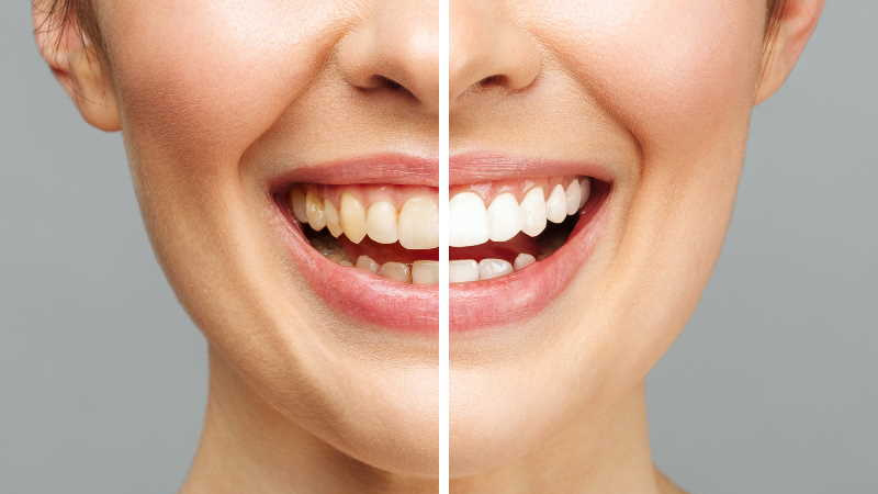 TEETH WHITENING